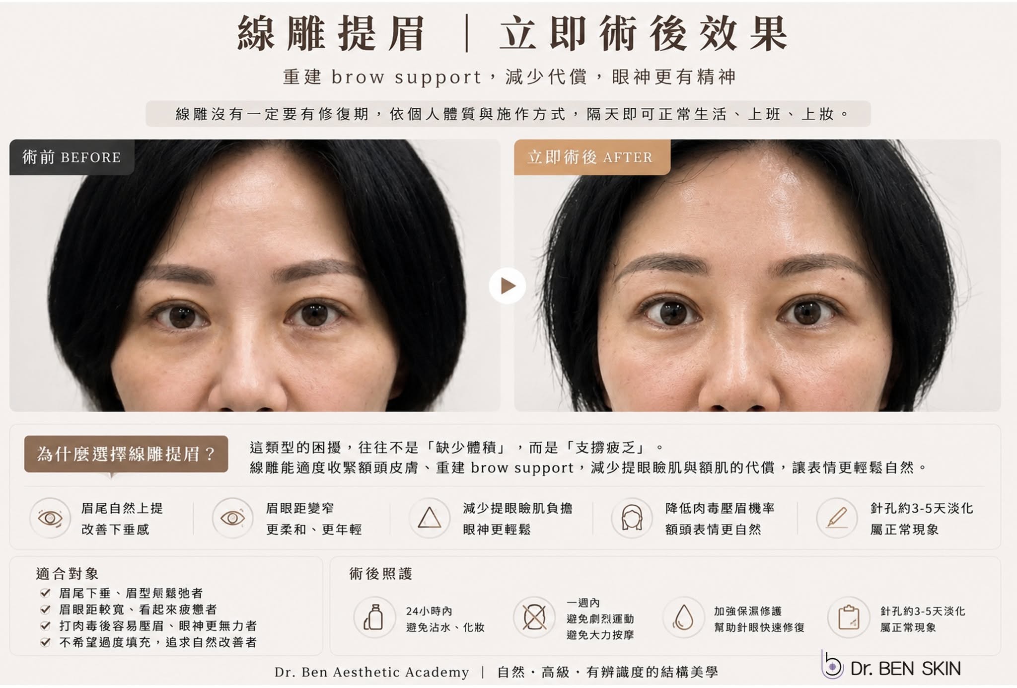 線雕提眉 brow support