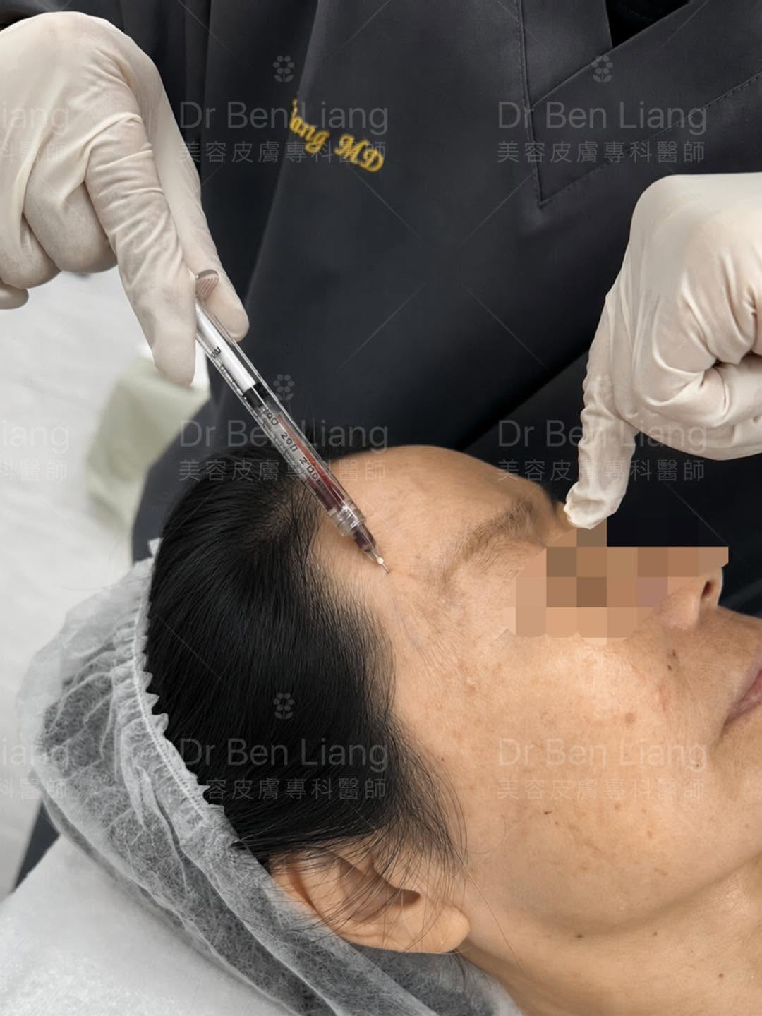 Dr Ben Liang 進行太陽穴淺層 superficial plane 注射操作示範