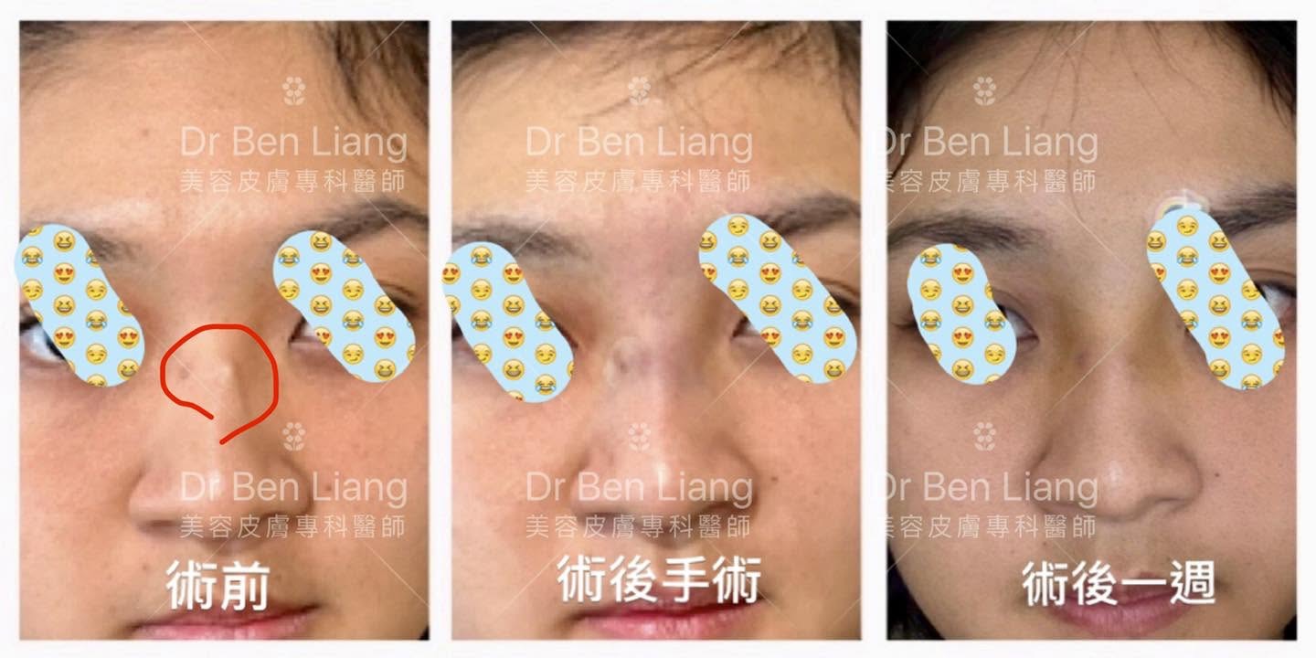 鼻線取線案例一 術前術後一週對比正面