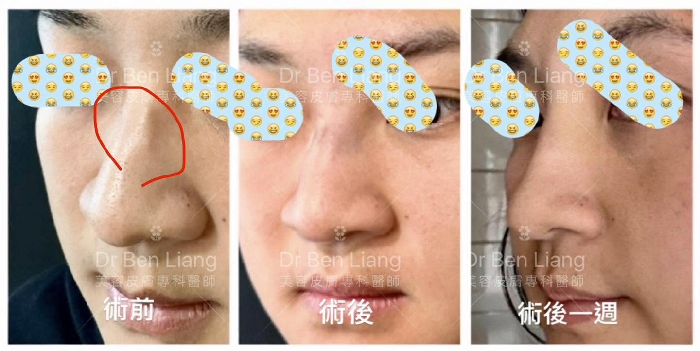 鼻線取線案例二 術前術後一週對比側面