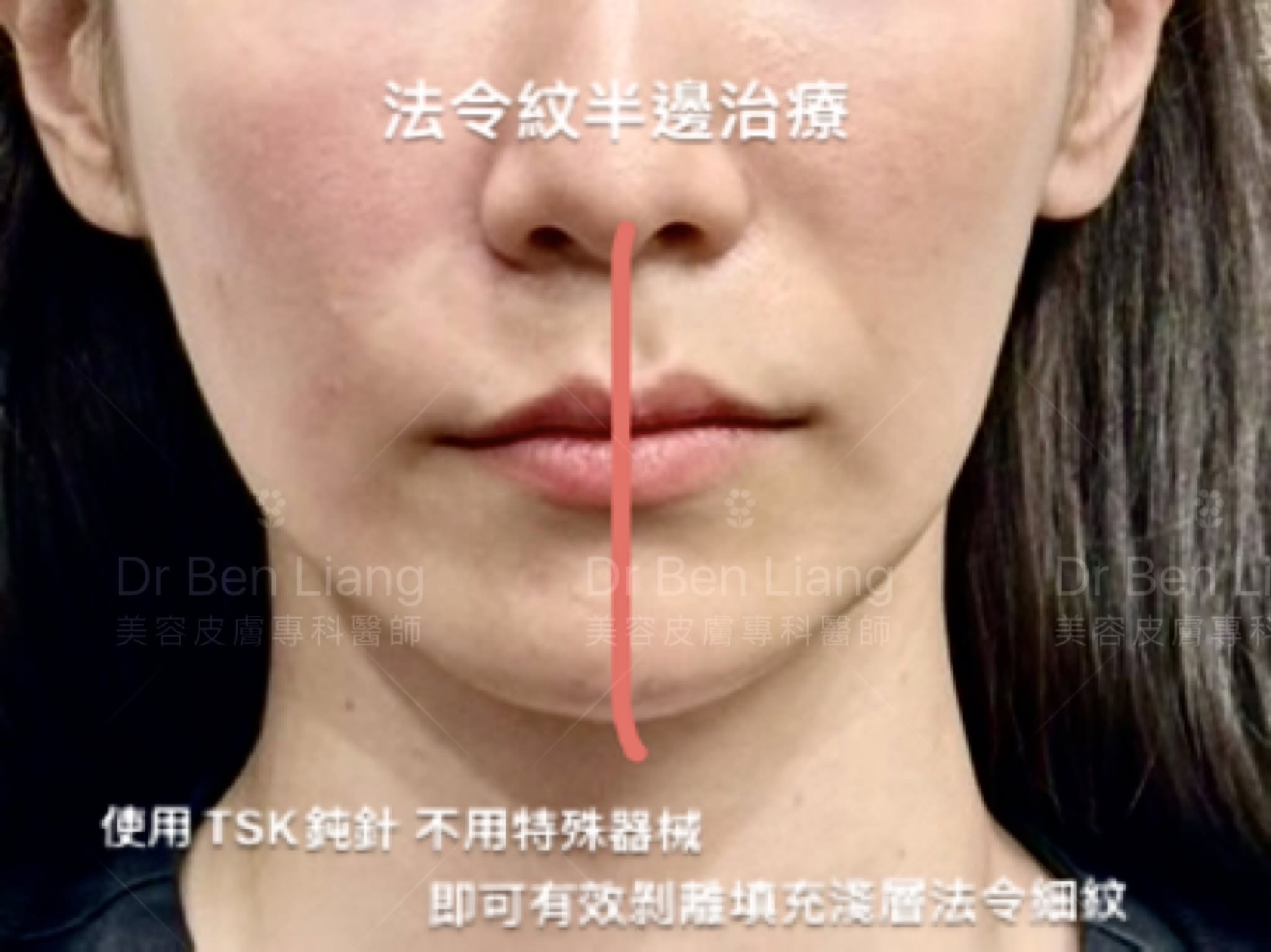 法令紋半邊治療示範：淺層消失術案例畫面
