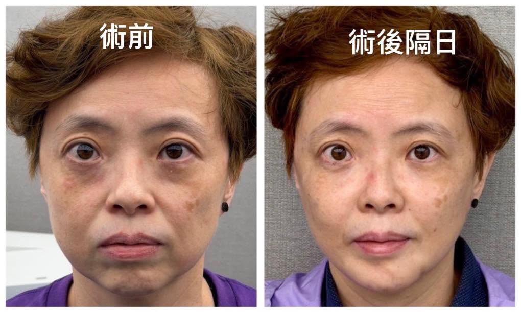 全臉尖針班術前術後案例對照，淚溝與中臉支撐改善