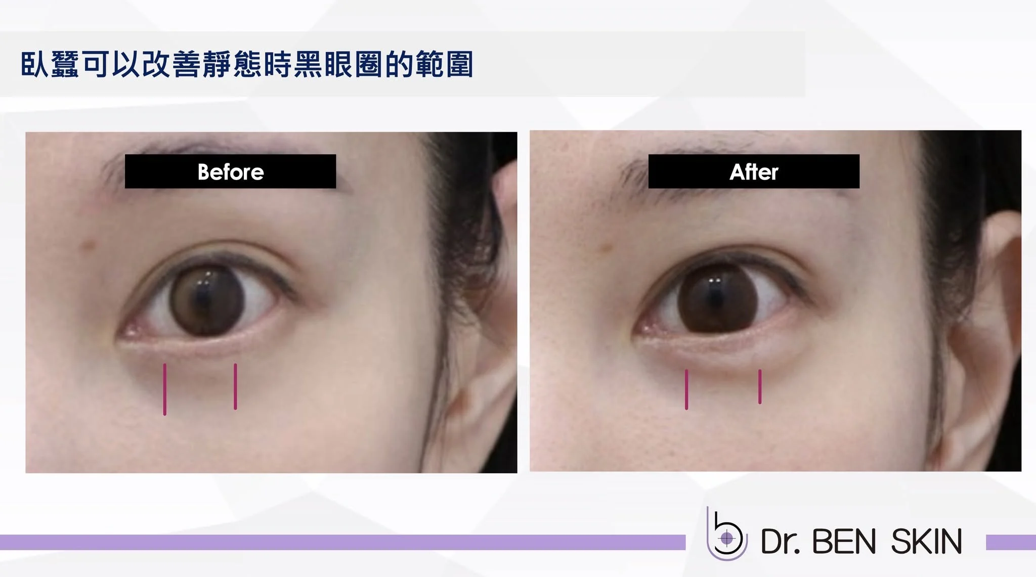 黑眼圈範圍與淚溝結構陰影治療前後比較