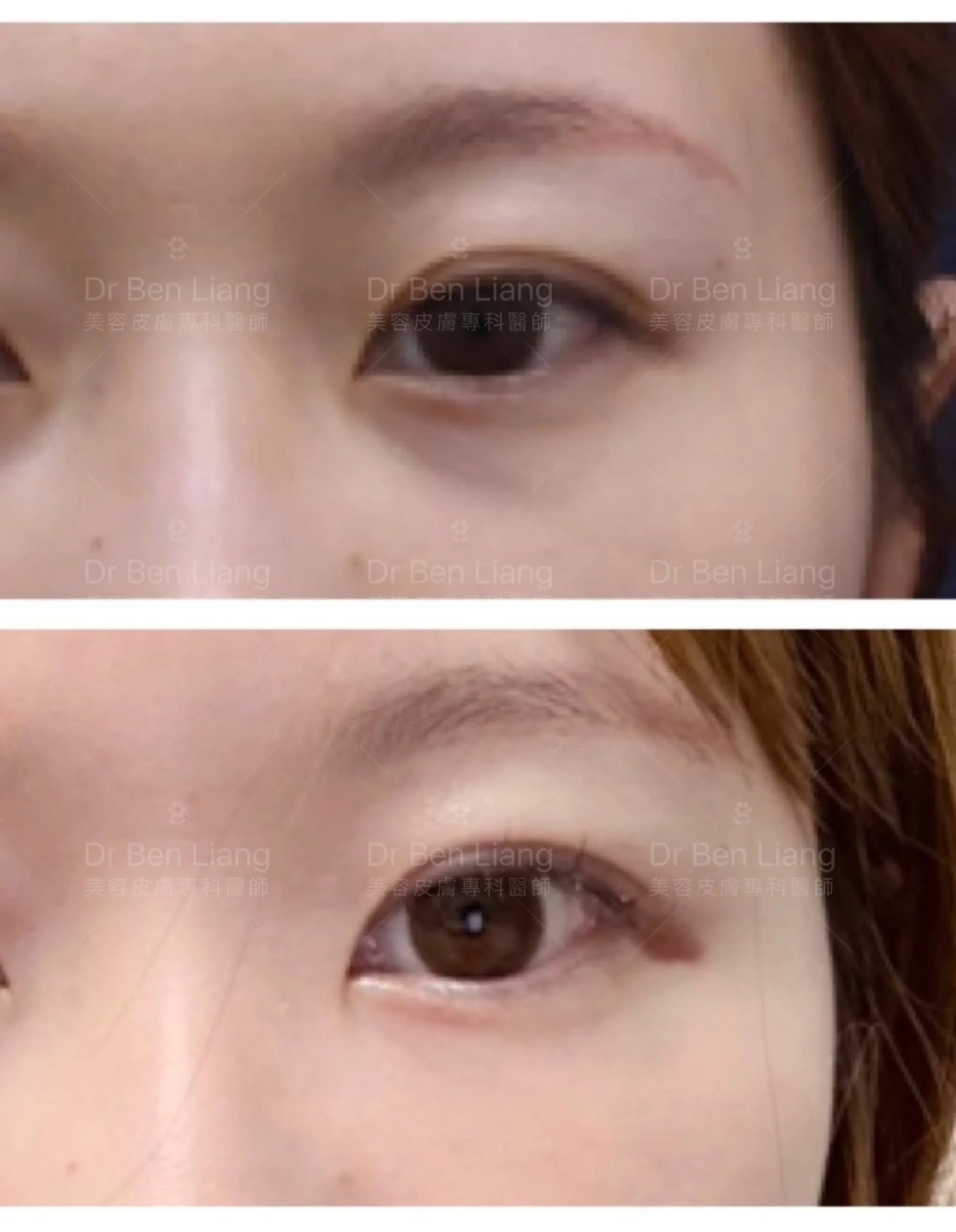 黑眼圈與眼下陰影治療術前術後眼周對照