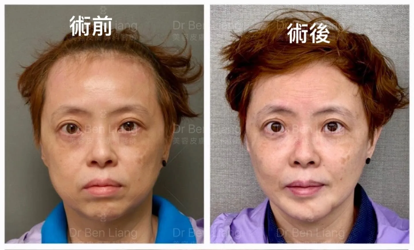 下區中軸治療術前術後正面案例對照