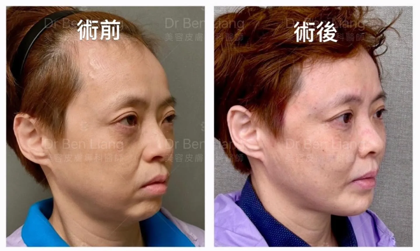 下區中軸治療術前術後側面案例對照