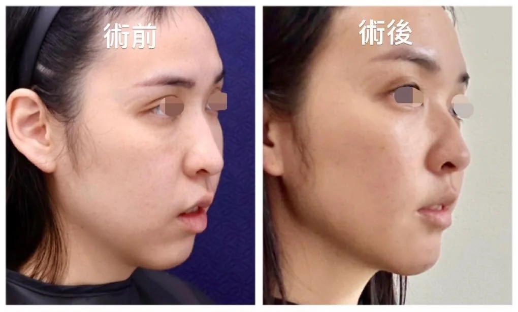 淚溝毛毛蟲修復與重建術前術後側面對照