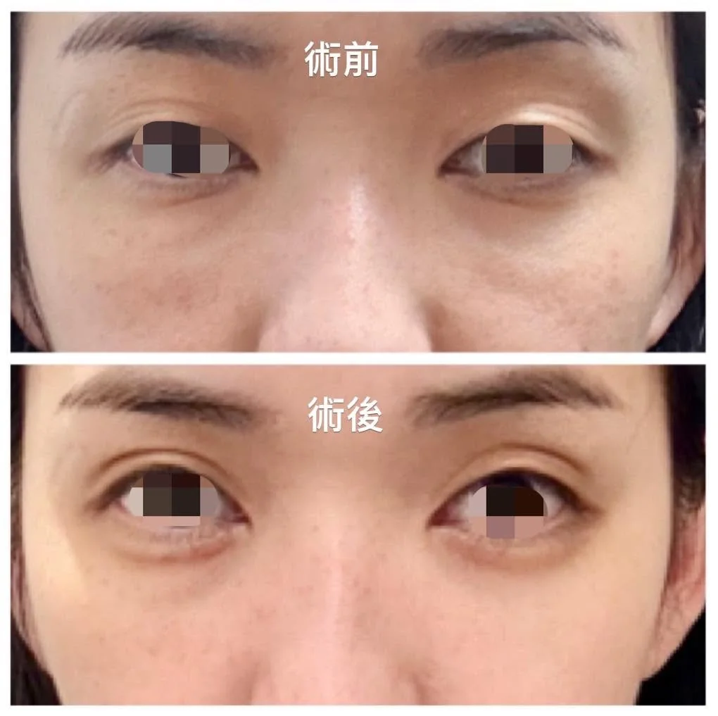 淚溝毛毛蟲眼下修復與重建近照對照