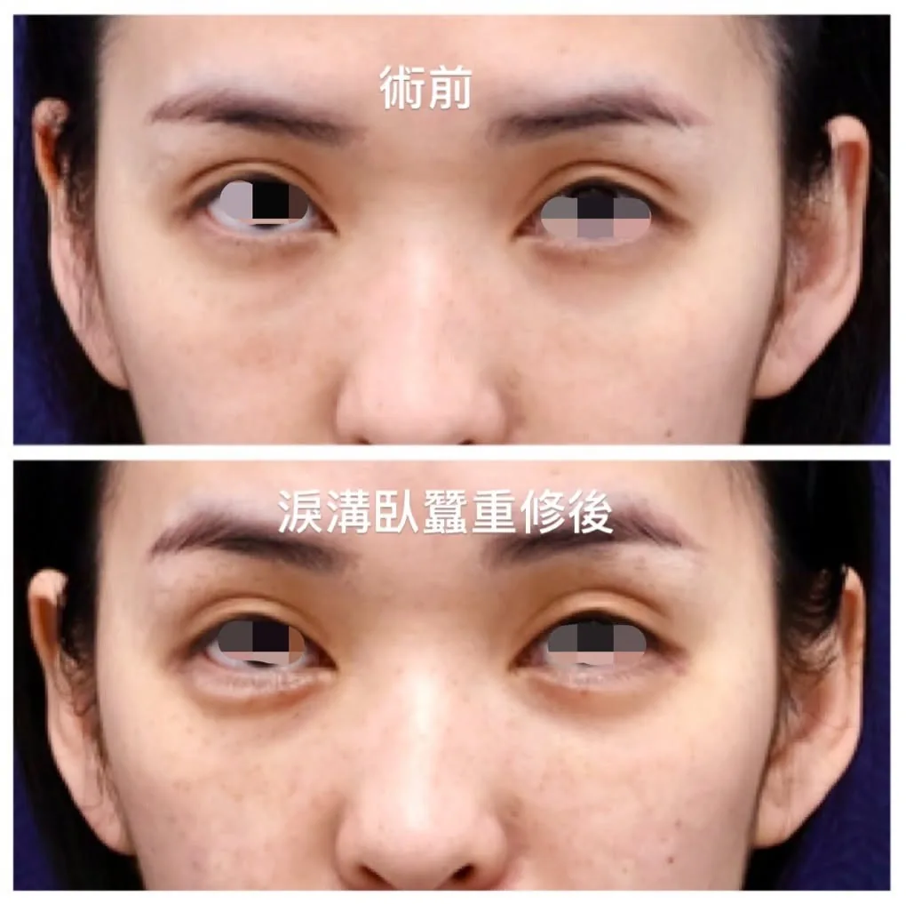 淚溝毛毛蟲術前靜態與微笑對照