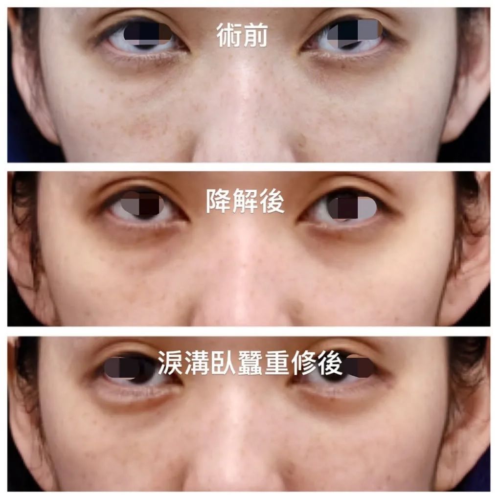 淚溝毛毛蟲精準降解後靜態與微笑對照