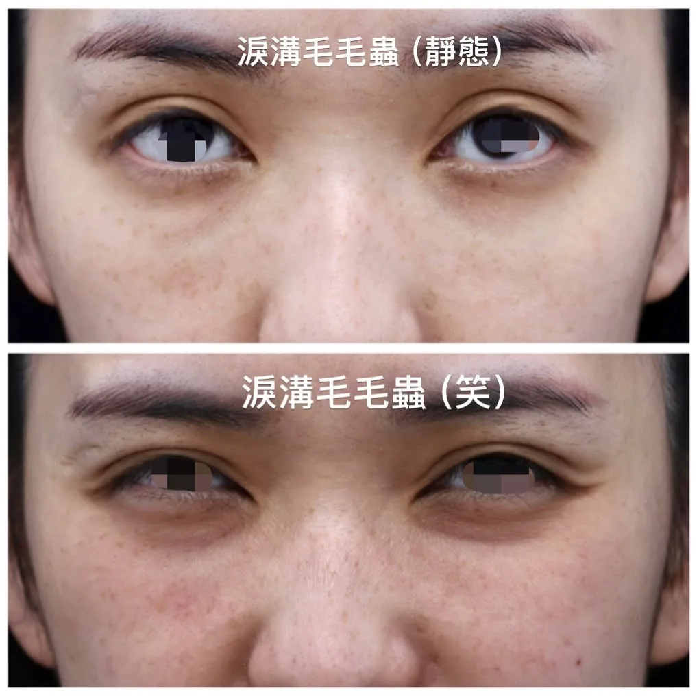 淚溝毛毛蟲術前與重修後比較