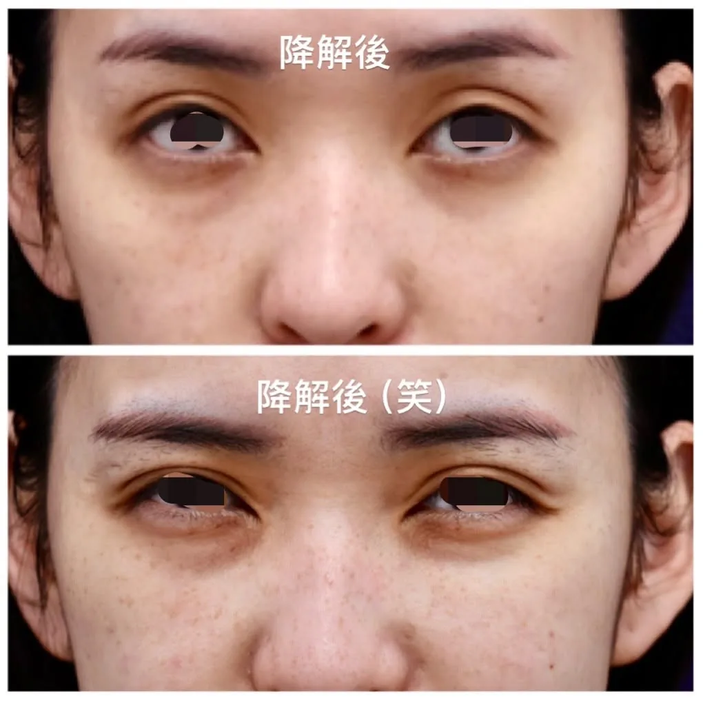淚溝毛毛蟲術前降解後與重修流程比較