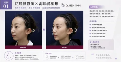 從全結構美學到個人化鼻型設計，駝峰鼻案例分析