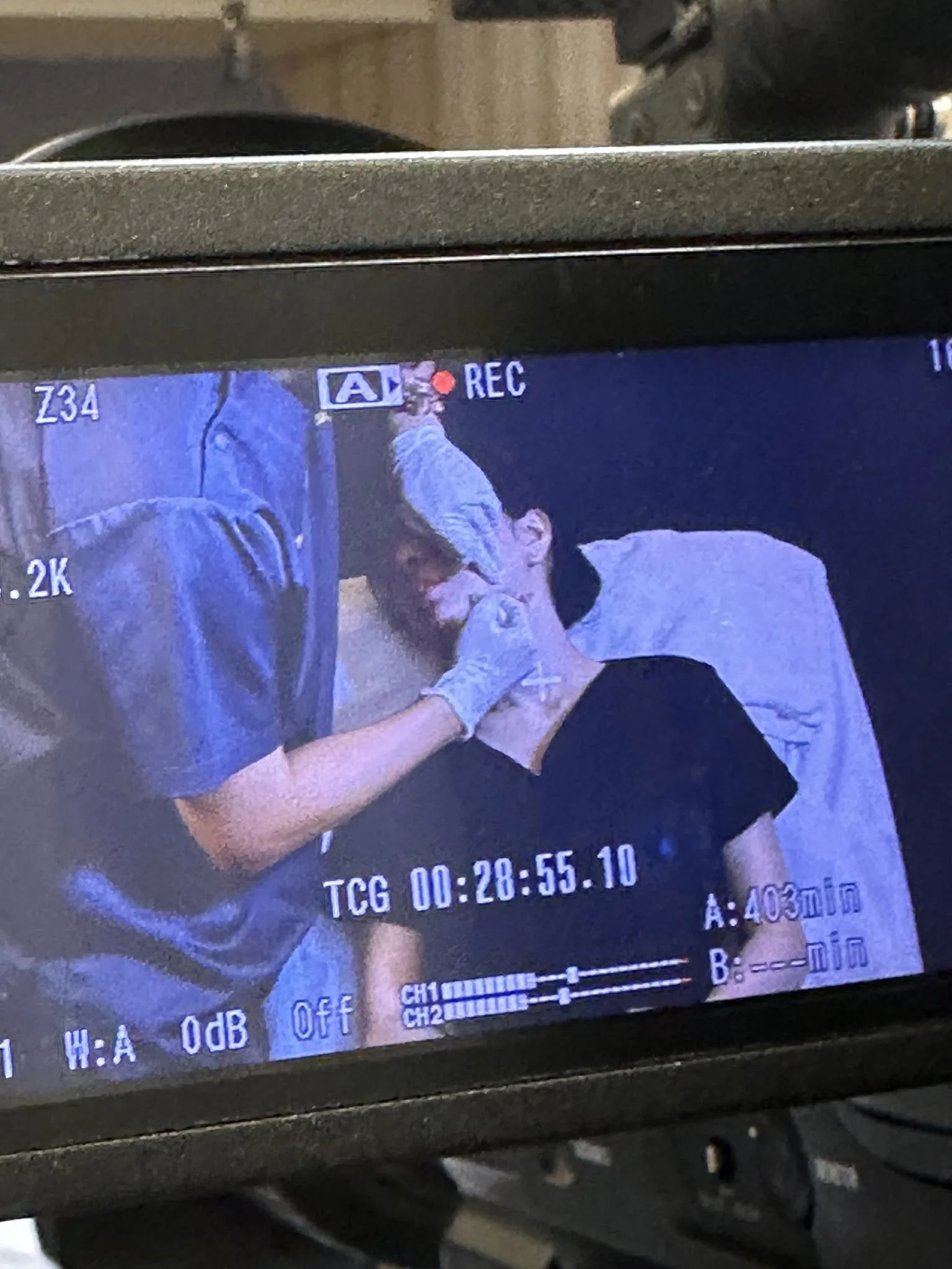 Profhilo 頸部治療示範錄製監看畫面
